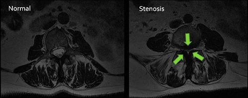 Normal and Stenosis 500X199