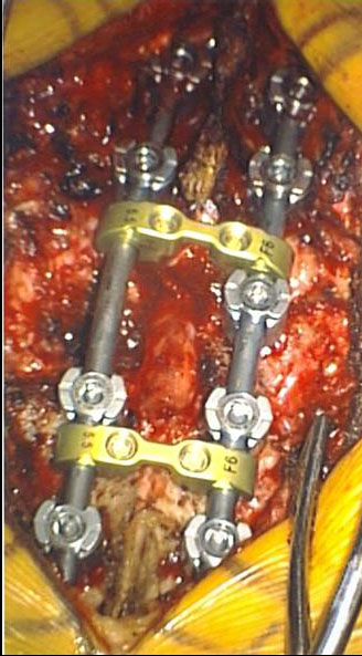 Open Lumbar Instrumentation
