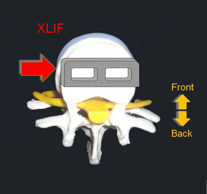 XLIF Slide